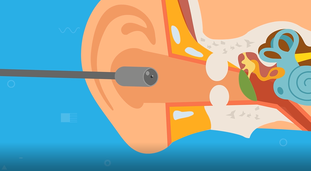 Surfer's Ear Diagnosis Is It Right For Me? Kitekahunas South Africa