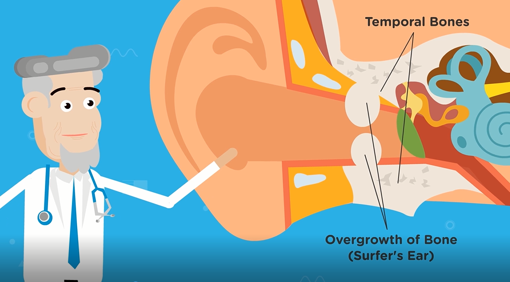 surfers ear growth