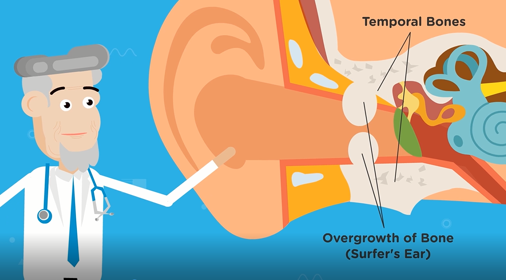 surfers ear wachstum